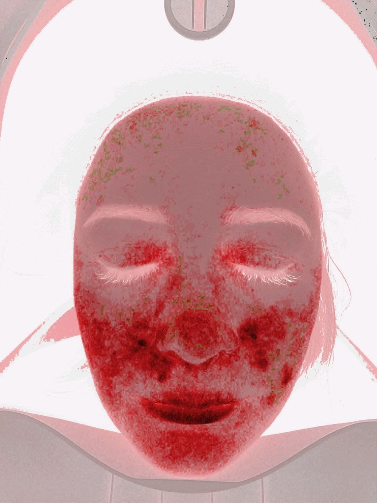 Fluorescencja porfiryn · analiza diagnostyczna — po kuracji