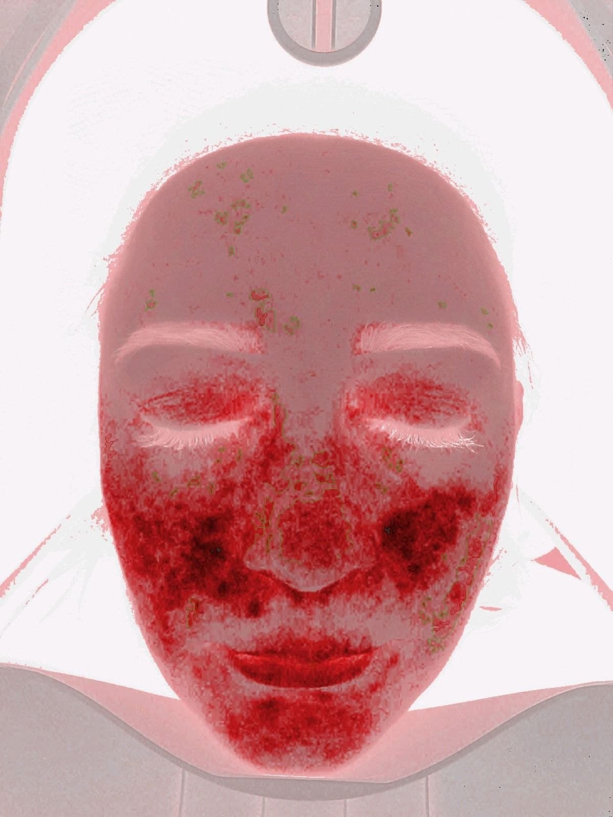 Fluorescencja porfiryn · analiza diagnostyczna — przed kuracją