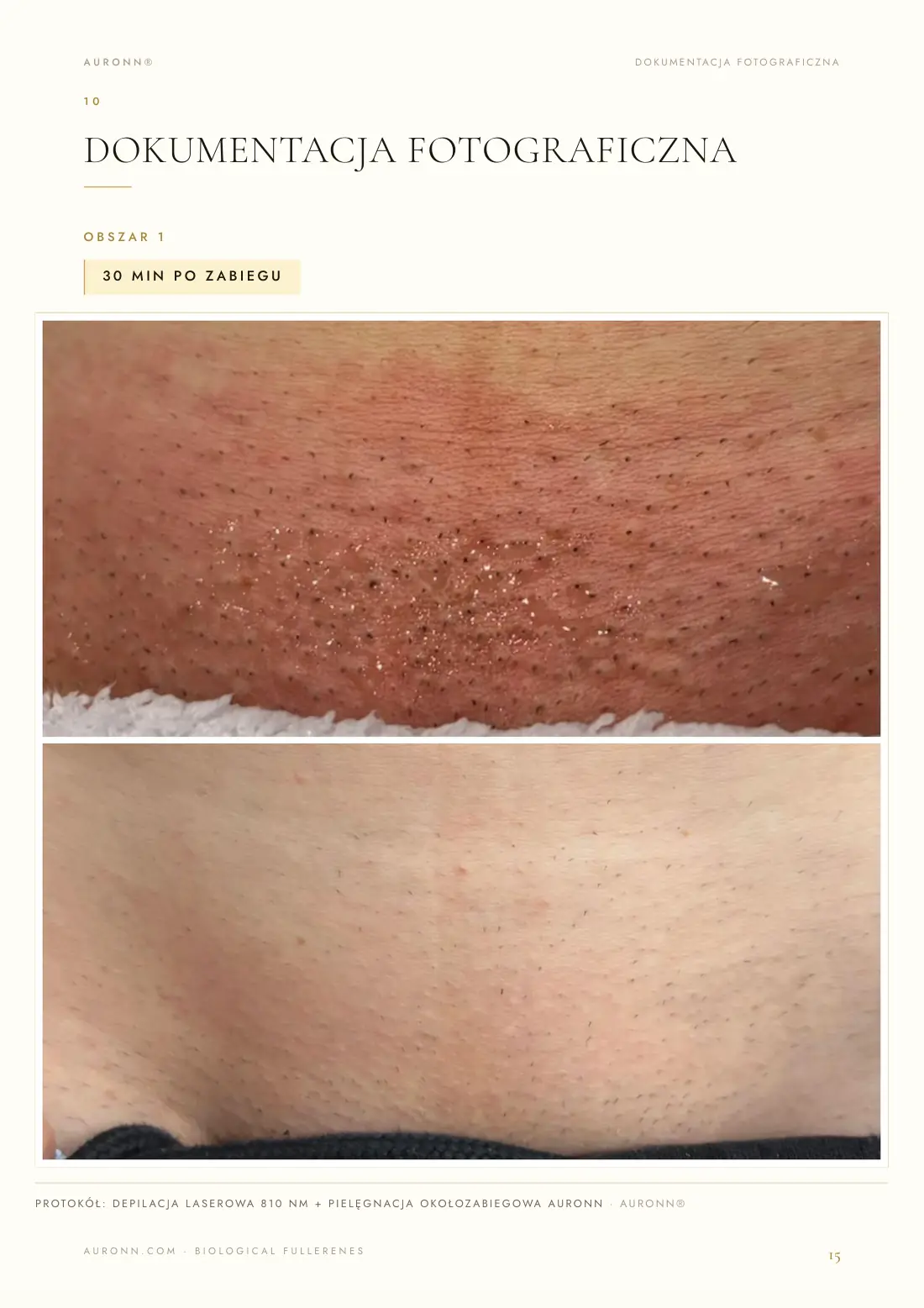 Depilacja laserowa — laser diodowy 810 nm + AURONN® — strona 15