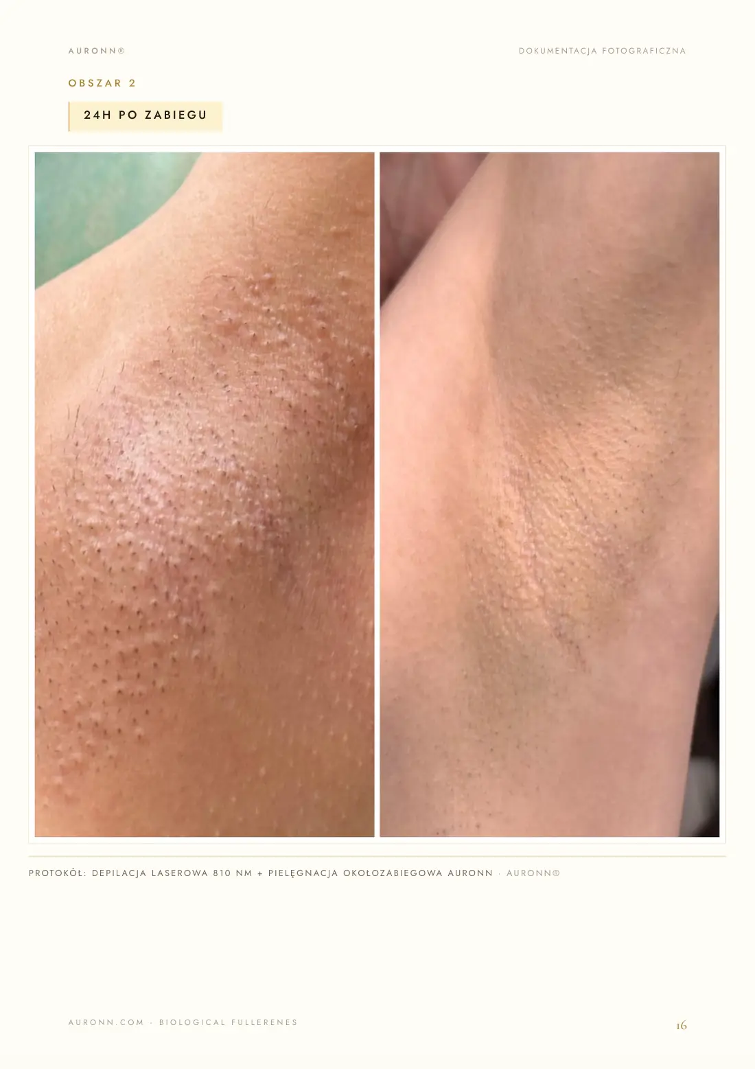 Depilacja laserowa — laser diodowy 810 nm + AURONN® — strona 16
