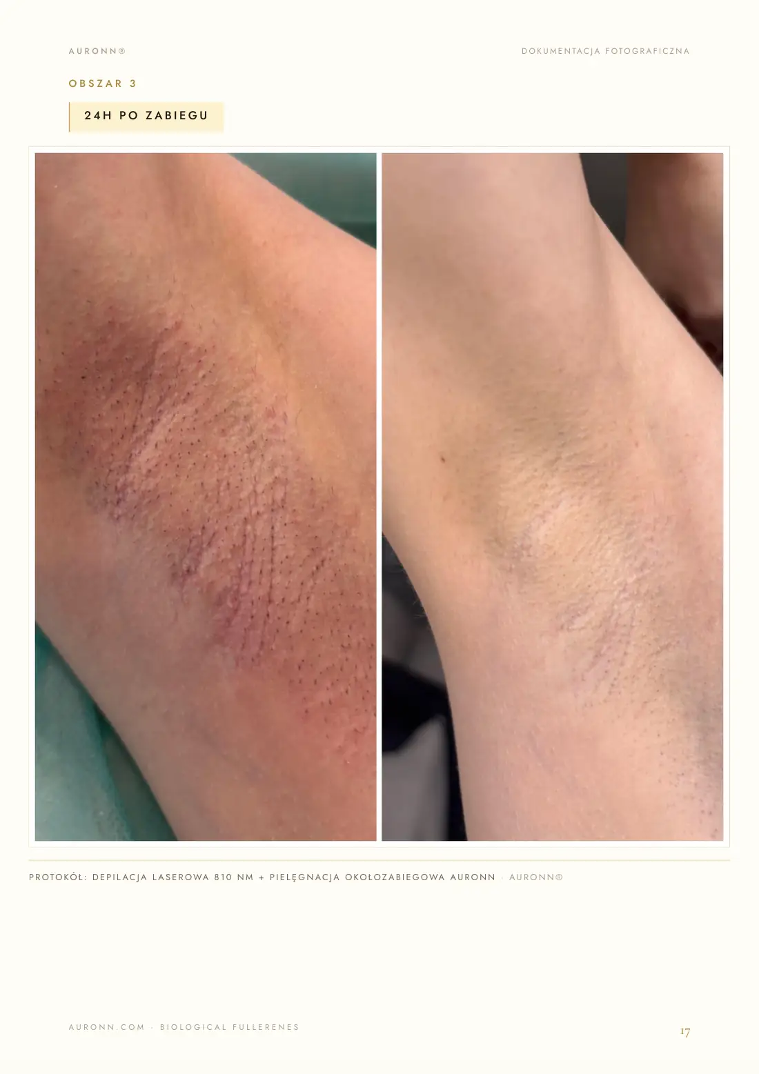 Depilacja laserowa — laser diodowy 810 nm + AURONN® — strona 17