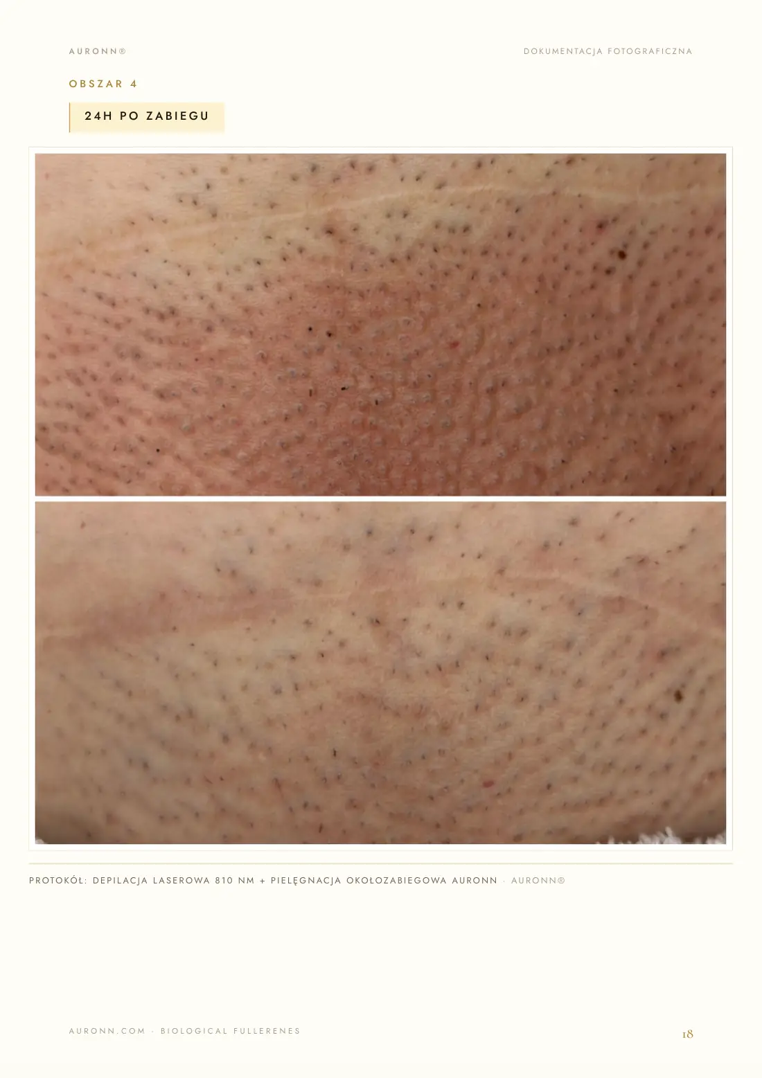 Depilacja laserowa — laser diodowy 810 nm + AURONN® — strona 18