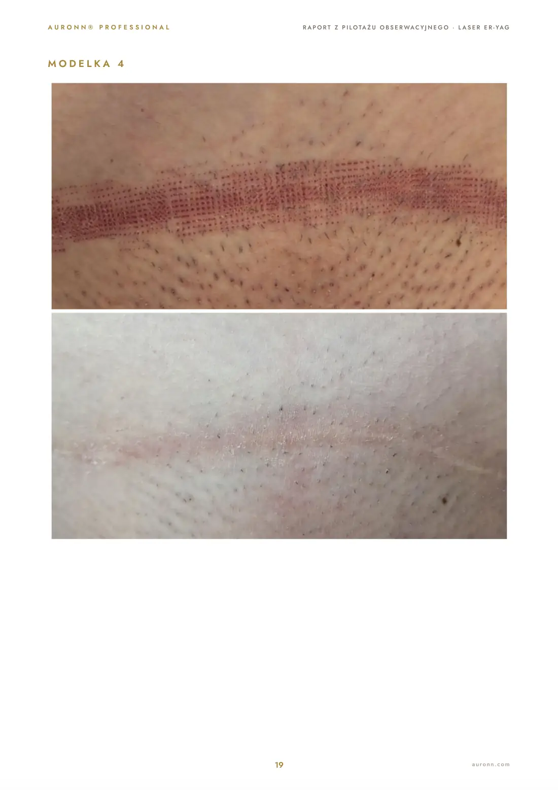 Laser iPixel Er:YAG 2940 nm (Alma Harmony) + AURONN® — strona 19