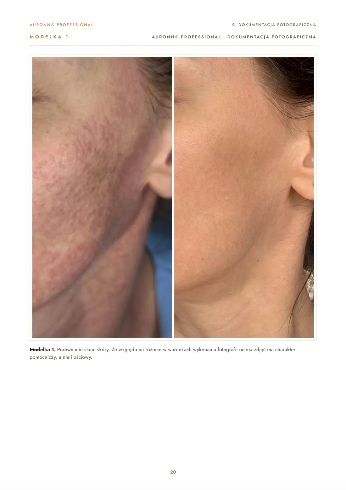 Regeneracja skóry po laserze tulowym 1927 nm + AURONN® — strona 20