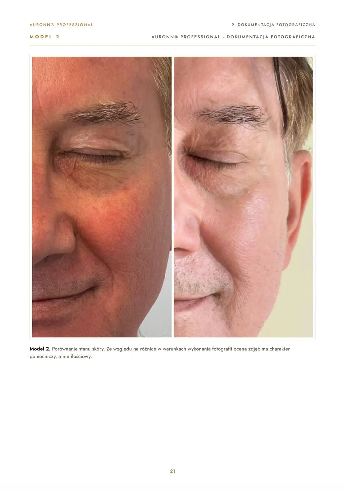 Regeneracja skóry po laserze tulowym 1927 nm + AURONN® — strona 21