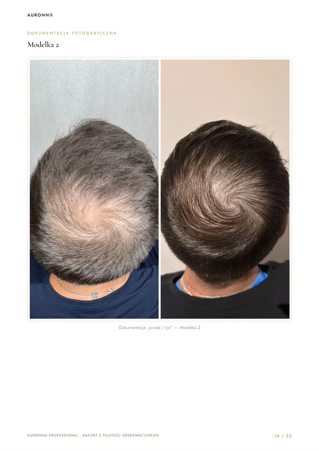 Mezoterapia igłowa skóry głowy Dr.CYJ + fotobiomodulacja LED + AURONN® — strona 16