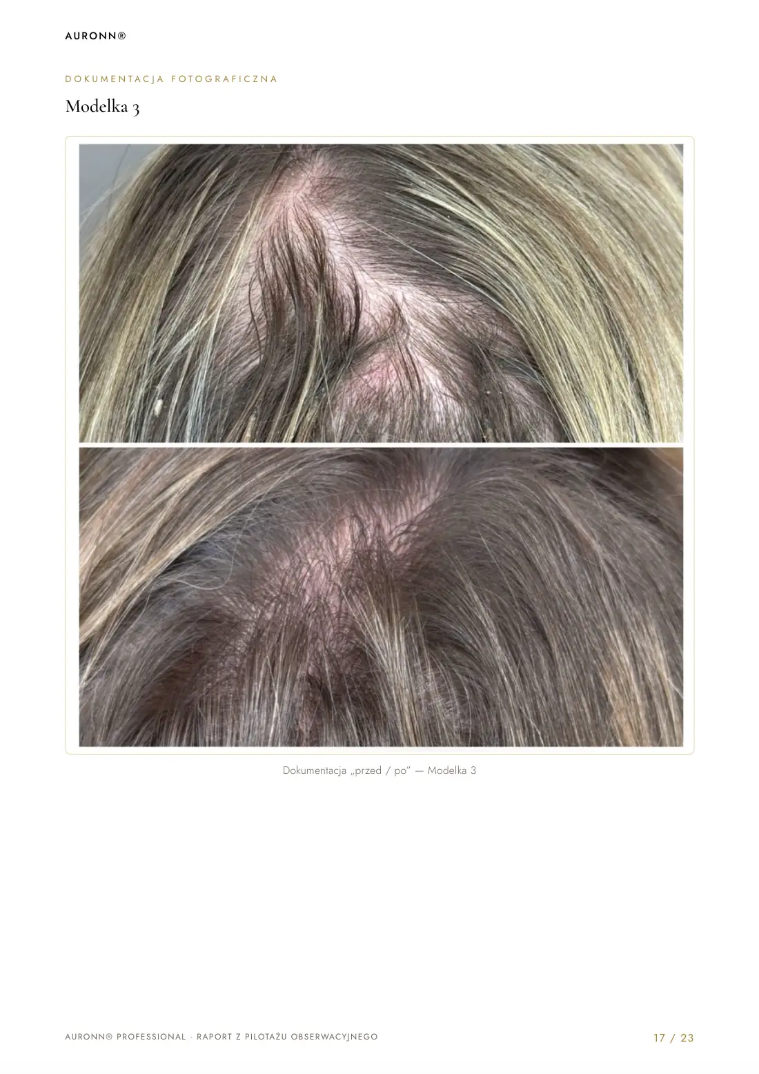 Mezoterapia igłowa skóry głowy Dr.CYJ + fotobiomodulacja LED + AURONN® — strona 17