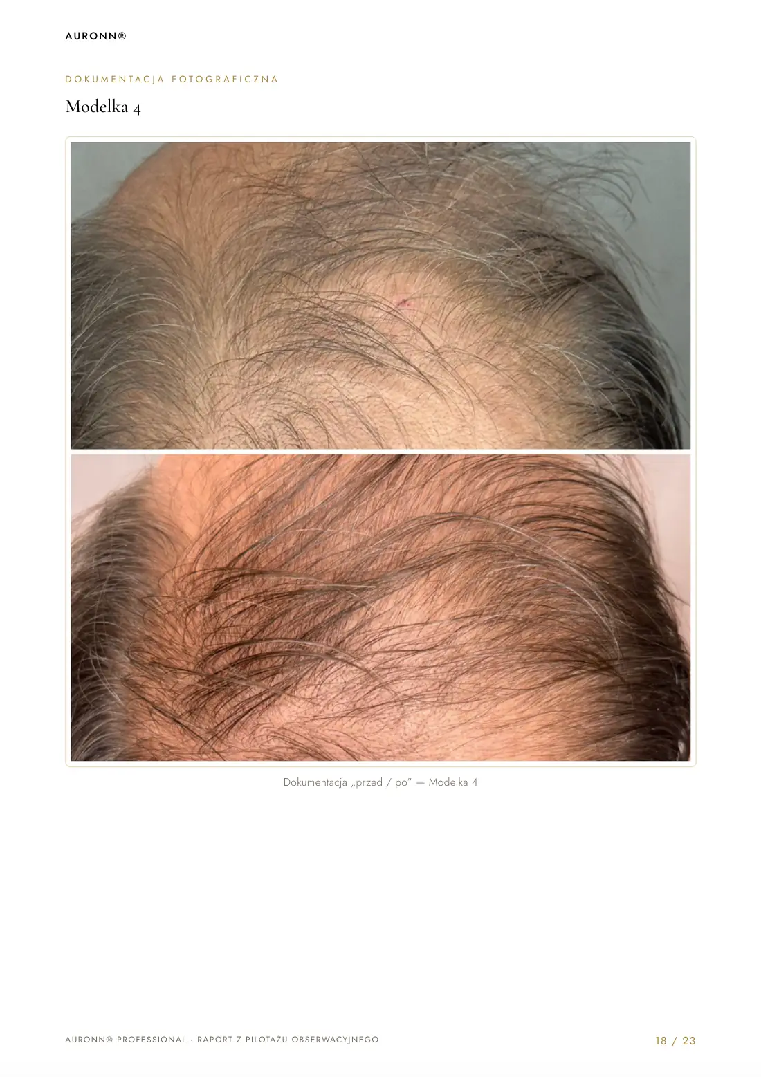 Mezoterapia igłowa skóry głowy Dr.CYJ + fotobiomodulacja LED + AURONN® — strona 18
