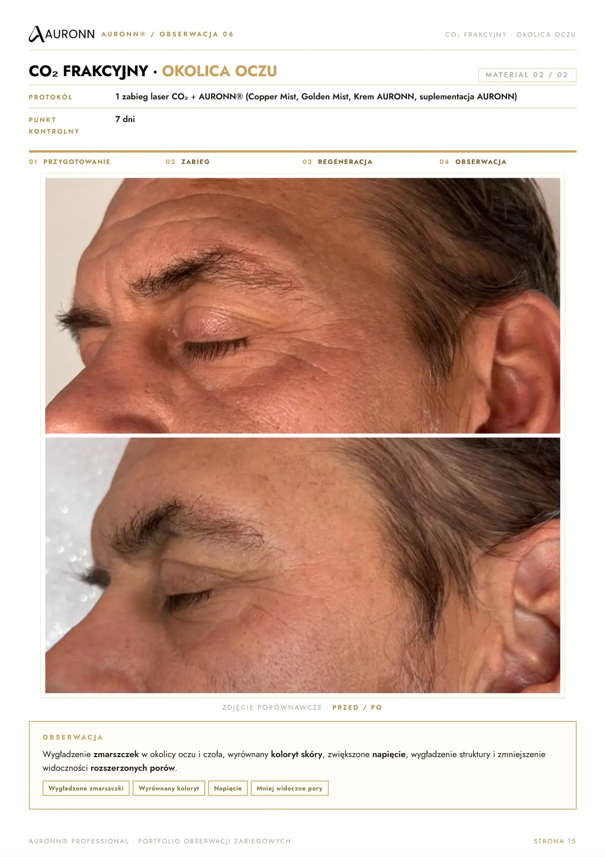AURONN® Portfolio obserwacji zabiegowych — strona 15